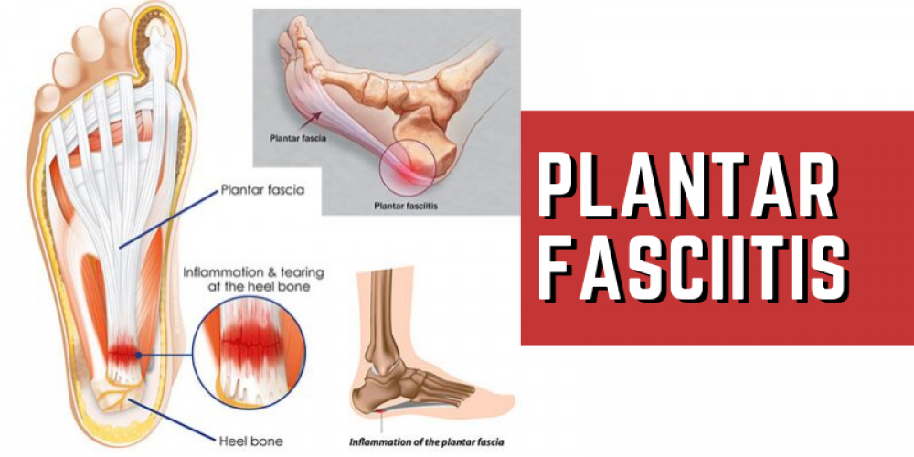 plantar fasciitis